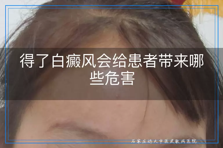 得了白癜风会给患者带来哪些危害