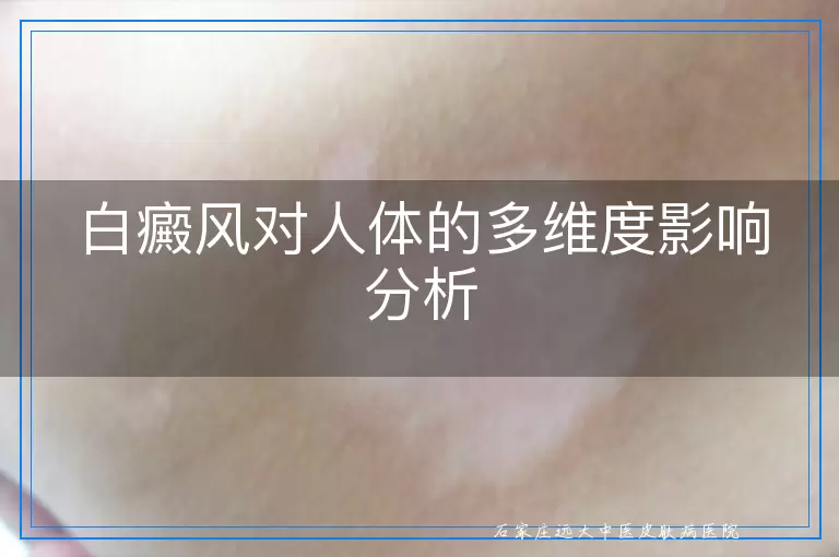 白癜风对人体的多维度影响分析