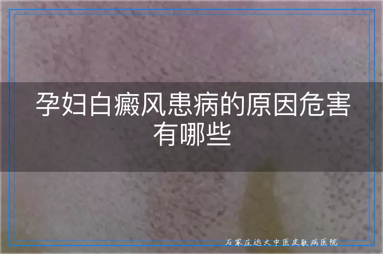 孕妇白癜风患病的原因危害有哪些