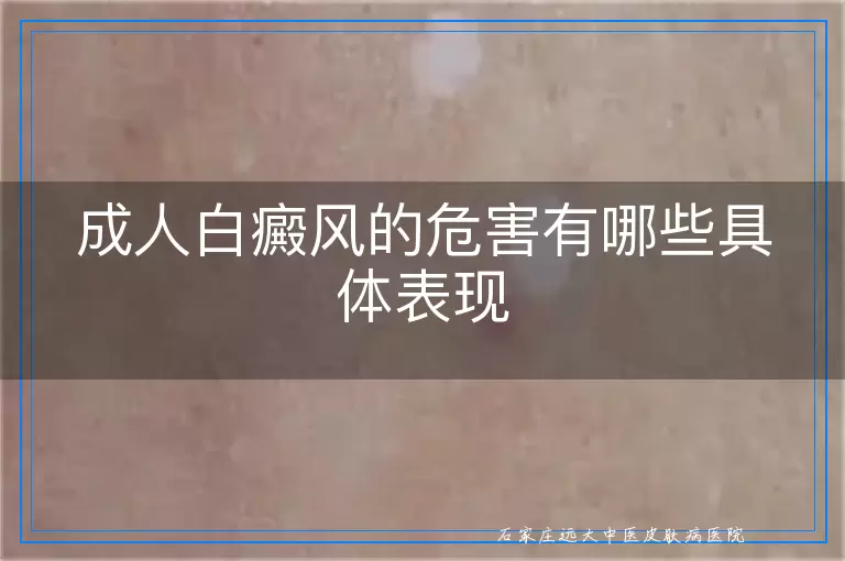 成人白癜风的危害有哪些具体表现
