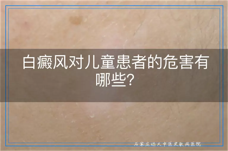 白癜风对儿童患者的危害有哪些？