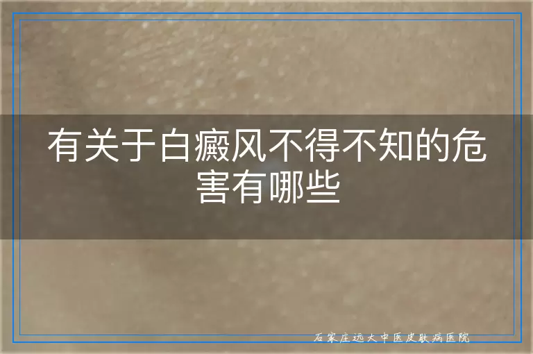 有关于白癜风不得不知的危害有哪些