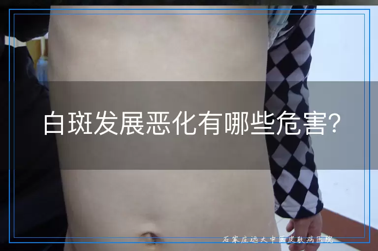 白斑发展恶化有哪些危害？