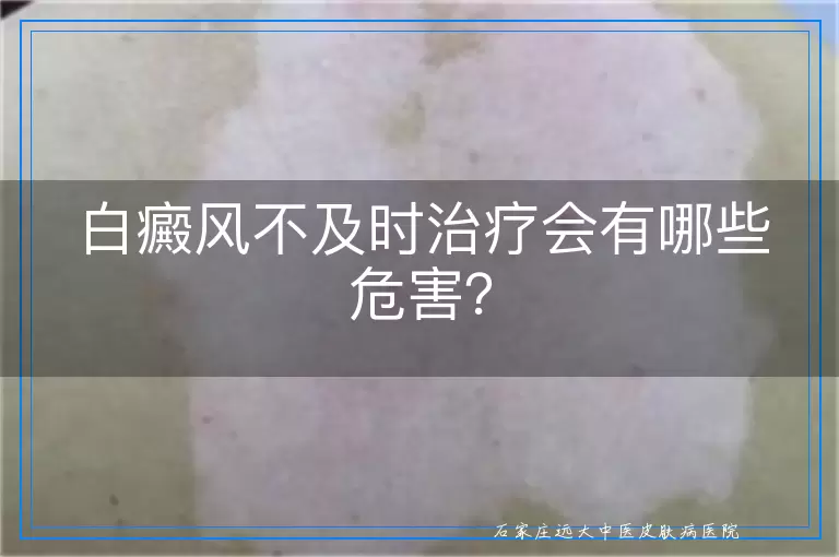 白癜风不及时治疗会有哪些危害？