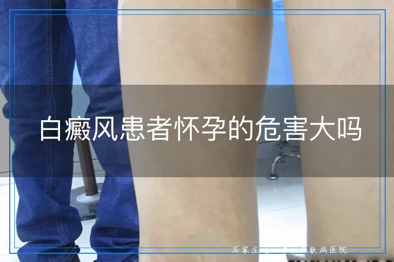 白癜风患者怀孕的危害大吗