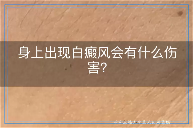 身上出现白癜风会有什么伤害？