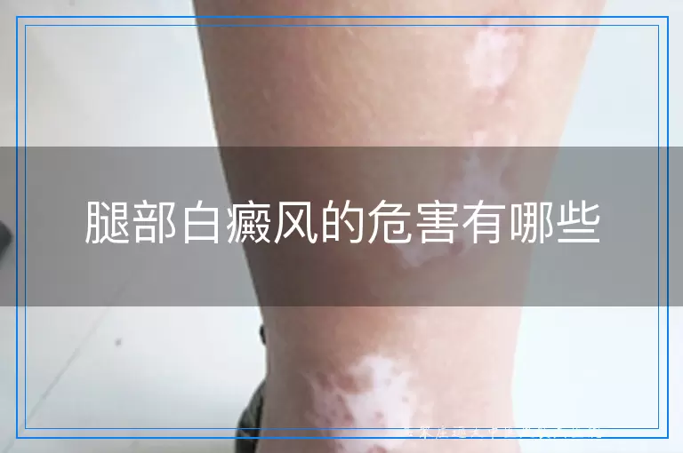 腿部白癜风的危害有哪些