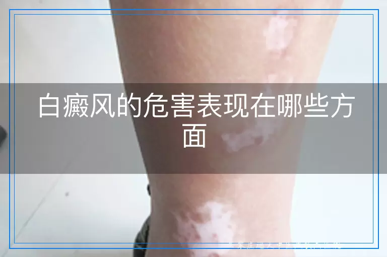 白癜风的危害表现在哪些方面
