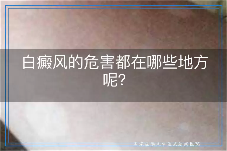 白癜风的危害都在哪些地方呢？