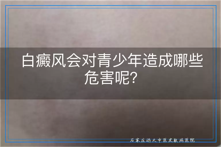 白癜风会对青少年造成哪些危害呢？