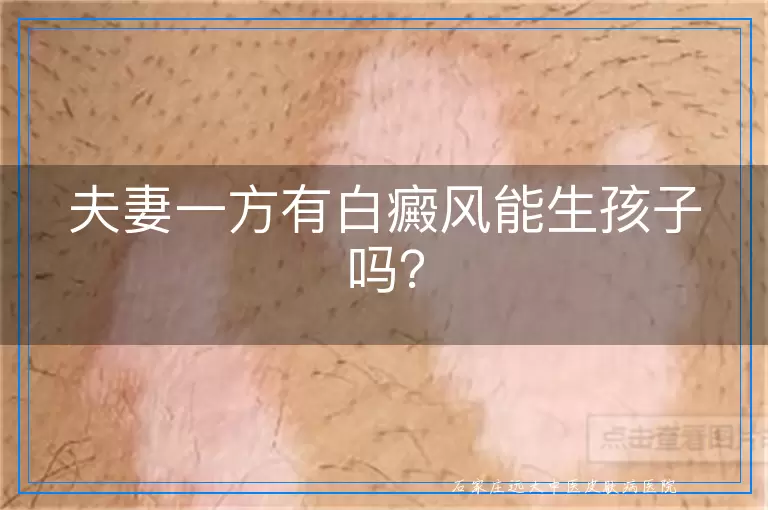夫妻一方有白癜风能生孩子吗？
