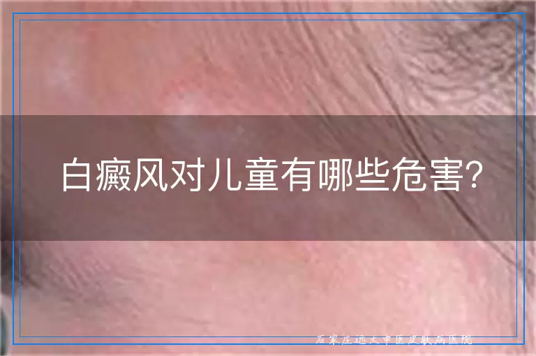 白癜风对儿童有哪些危害？