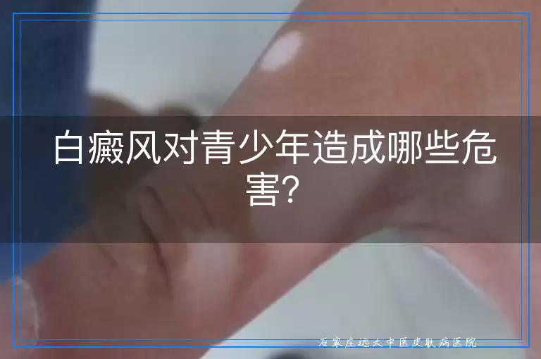 白癜风对青少年造成哪些危害？