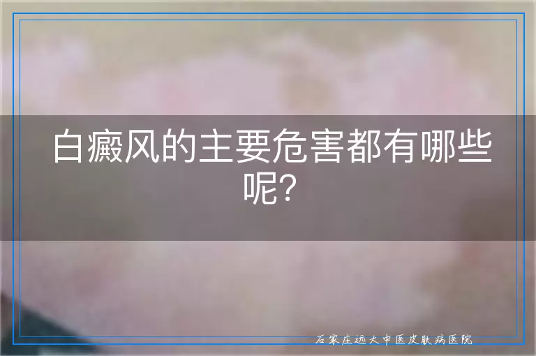 白癜风的主要危害都有哪些呢？