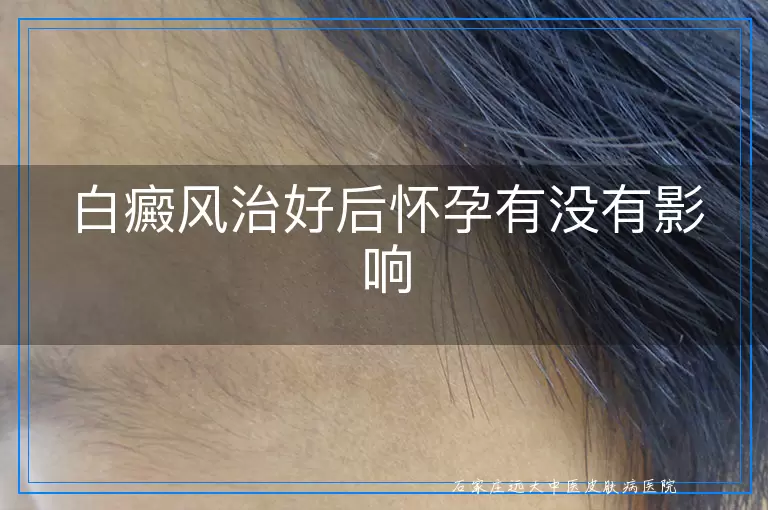 白癜风治好后怀孕有没有影响