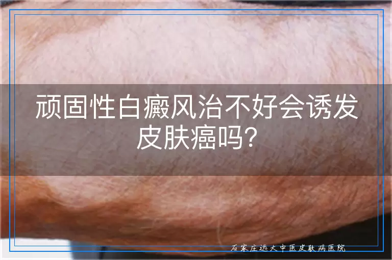 顽固性白癜风治不好会诱发皮肤癌吗？
