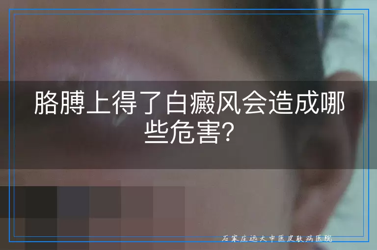 胳膊上得了白癜风会造成哪些危害？