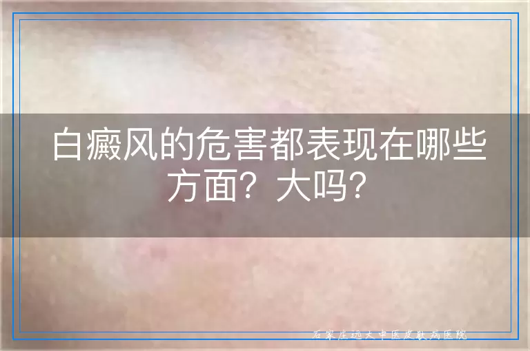 白癜风的危害都表现在哪些方面？大吗？