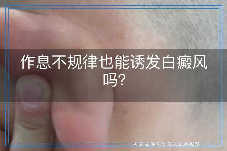 作息不规律也能诱发白癜风吗？