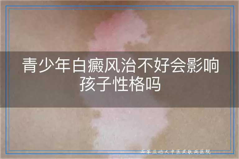 青少年白癜风治不好会影响孩子性格吗
