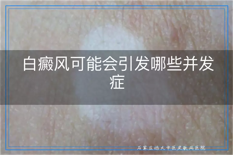 白癜风可能会引发哪些并发症
