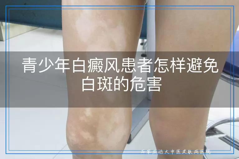 青少年白癜风患者怎样避免白斑的危害