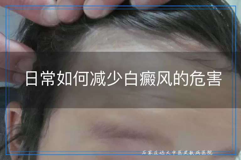 日常如何减少白癜风的危害