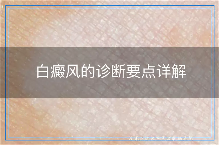 白癜风的诊断要点详解