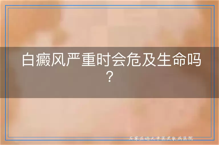 白癜风严重时会危及生命吗？