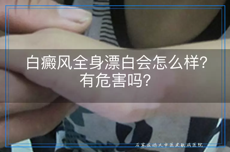白癜风全身漂白会怎么样？有危害吗？