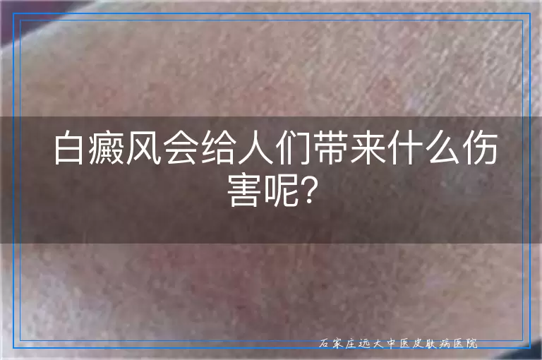 白癜风会给人们带来什么伤害呢？