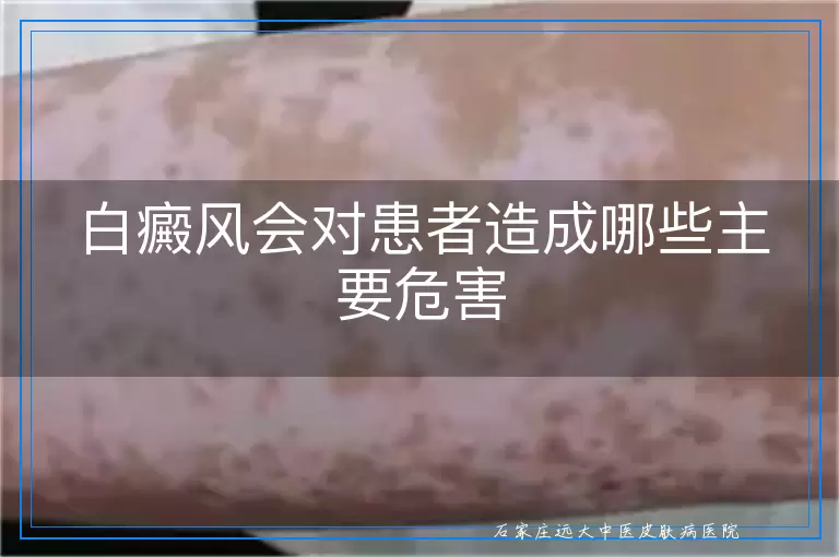 白癜风会对患者造成哪些主要危害