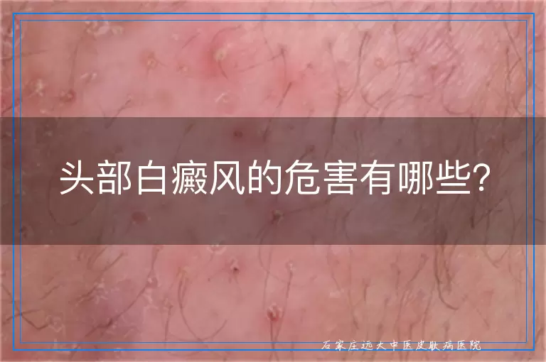 头部白癜风的危害有哪些？