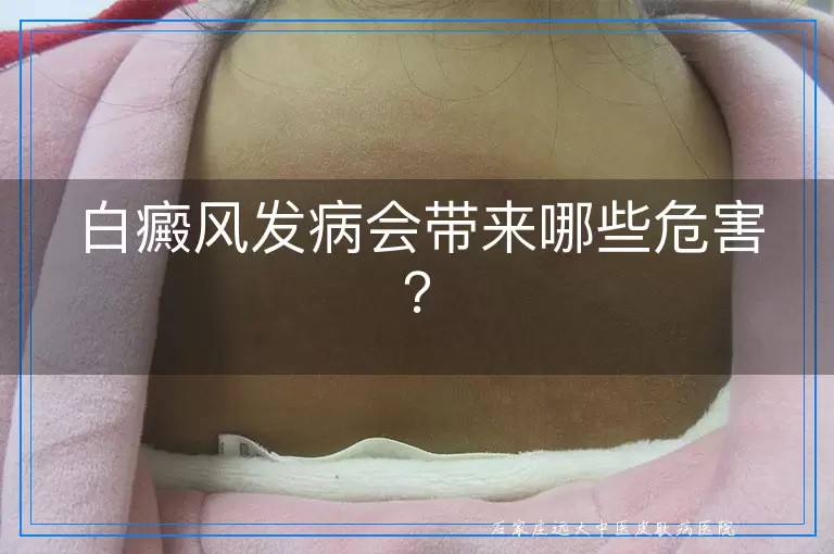 白癜风发病会带来哪些危害？