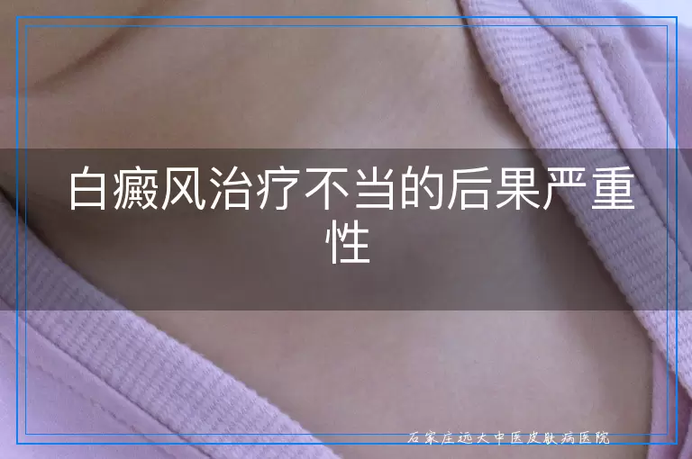 白癜风治疗不当的后果严重性