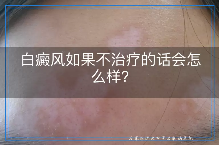 白癜风如果不治疗的话会怎么样？