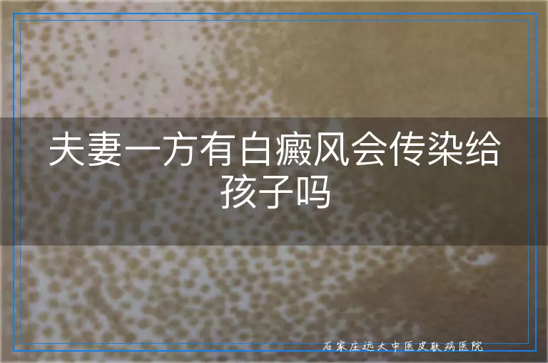 夫妻一方有白癜风会传染给孩子吗