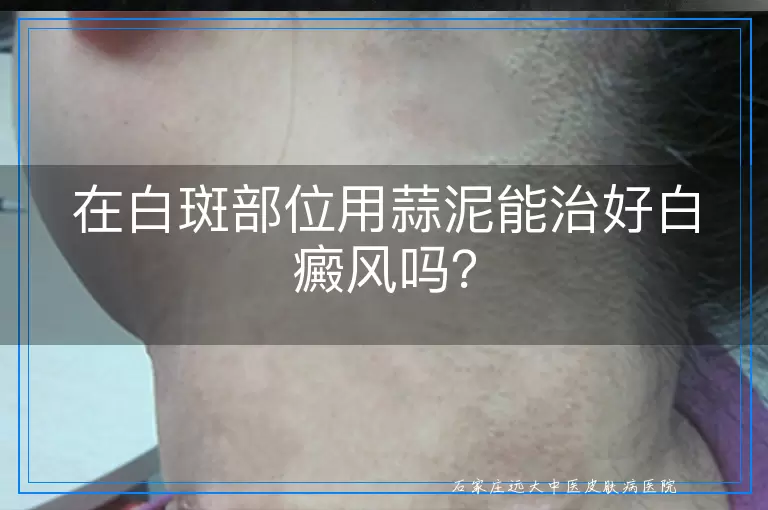 在白斑部位用蒜泥能治好白癜风吗？