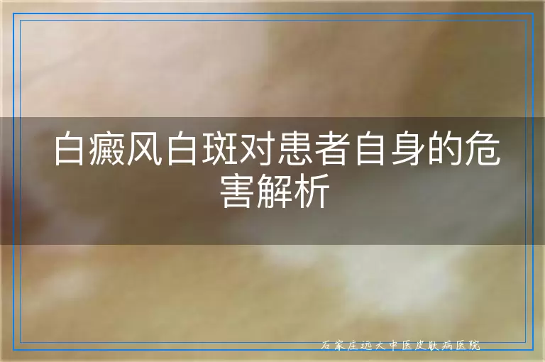 白癜风白斑对患者自身的危害解析