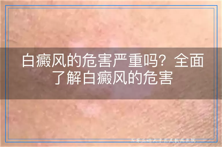 白癜风的危害严重吗？全面了解白癜风的危害