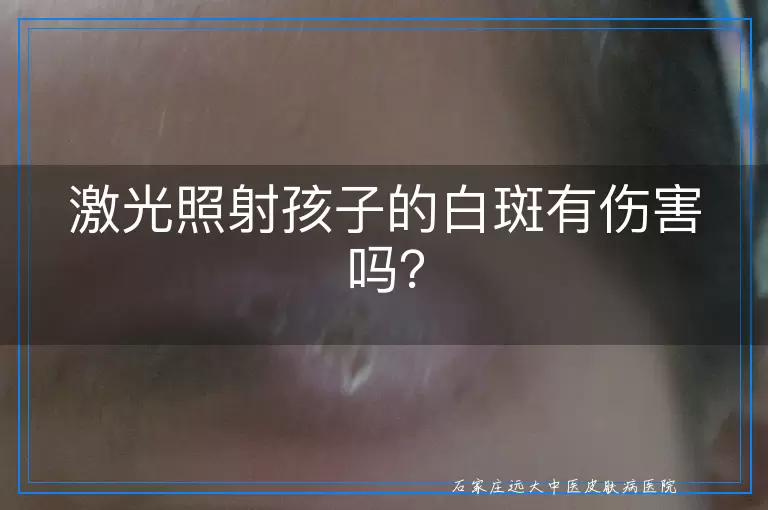 激光照射孩子的白斑有伤害吗？