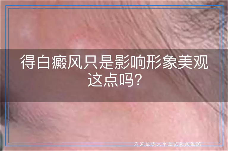 得白癜风只是影响形象美观这点吗？
