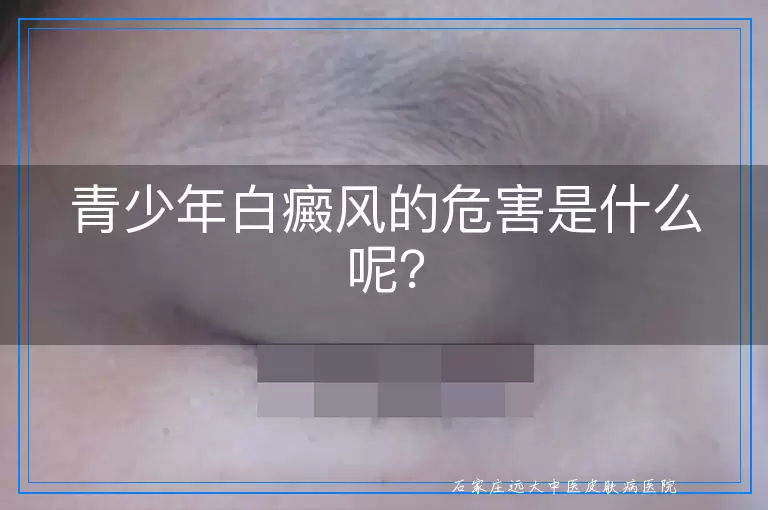 青少年白癜风的危害是什么呢？