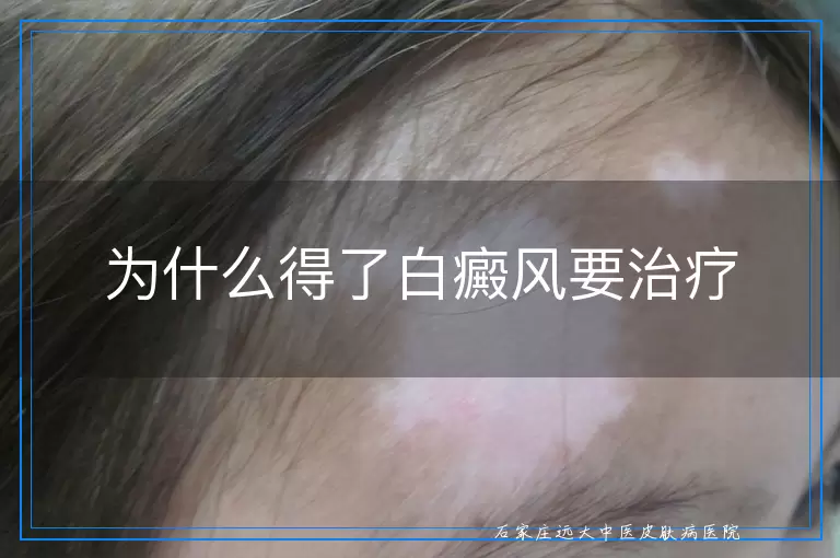 为什么得了白癜风要治疗