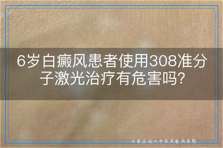 6岁白癜风患者使用308准分子激光治疗有危害吗？