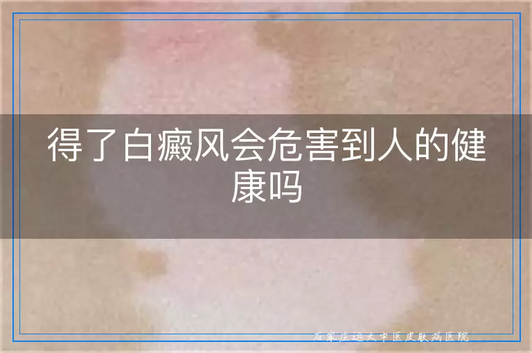 得了白癜风会危害到人的健康吗