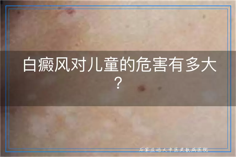白癜风对儿童的危害有多大？