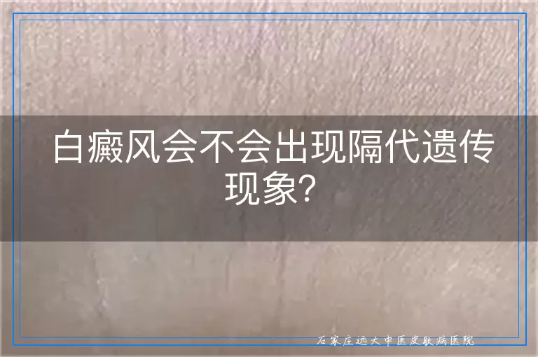 白癜风会不会出现隔代遗传现象？