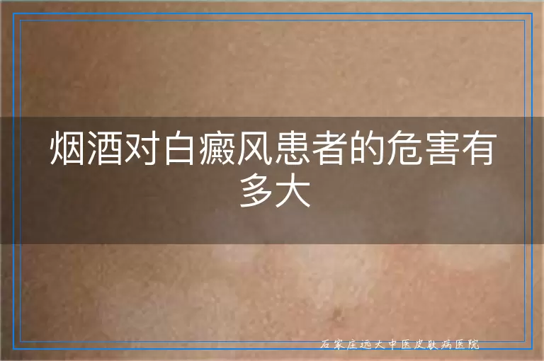 烟酒对白癜风患者的危害有多大