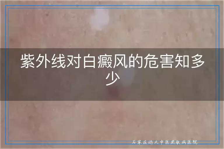 紫外线对白癜风的危害知多少